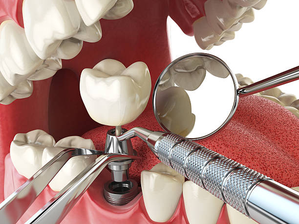 Best Emergency Treatment for Dental Infections or Abscesses in Butler, IN